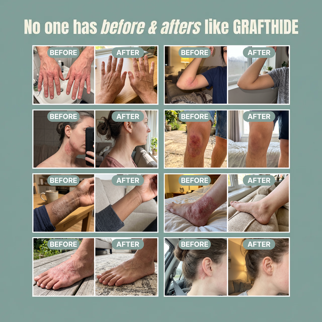GRAFTHIDE ECZEMA &amp; DRY SKIN REPAIR BALM